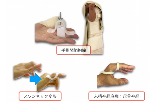 装具療法(スプリント)