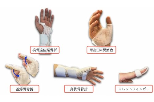 装具療法(スプリント)
